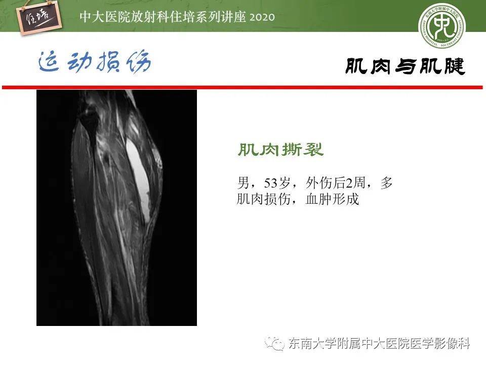 影像PPT - 【PPT】运动损伤的影像解读-42