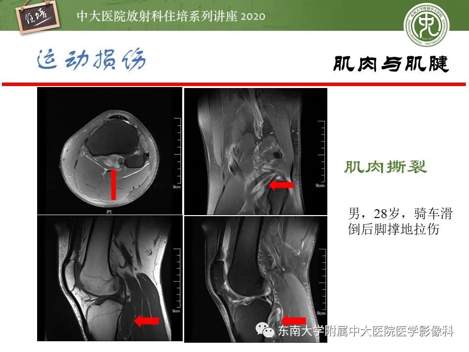 影像PPT - 【PPT】运动损伤的影像解读-43