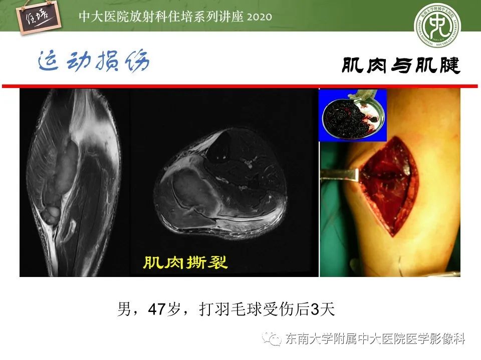影像PPT - 【PPT】运动损伤的影像解读-44