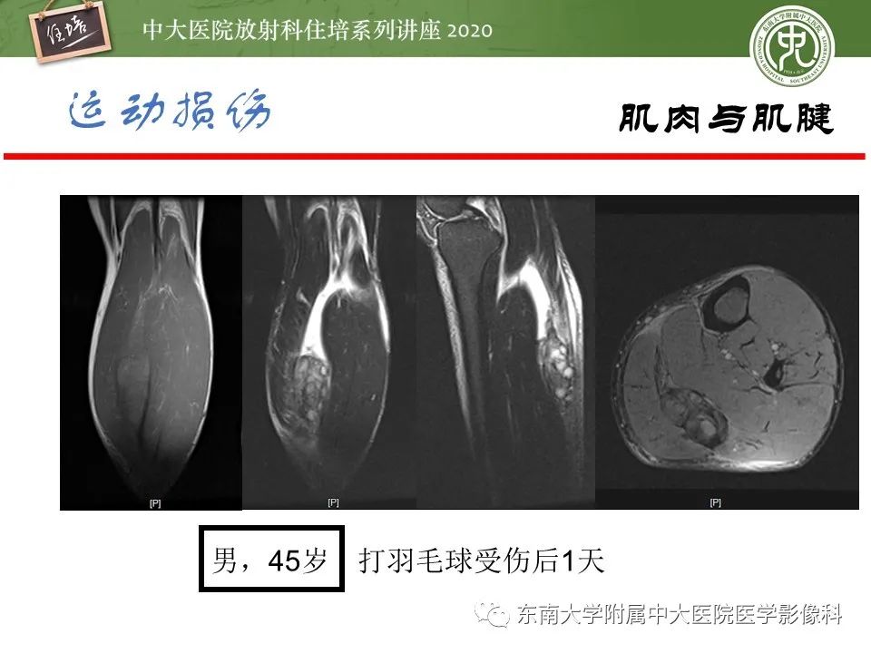 影像PPT - 【PPT】运动损伤的影像解读-45