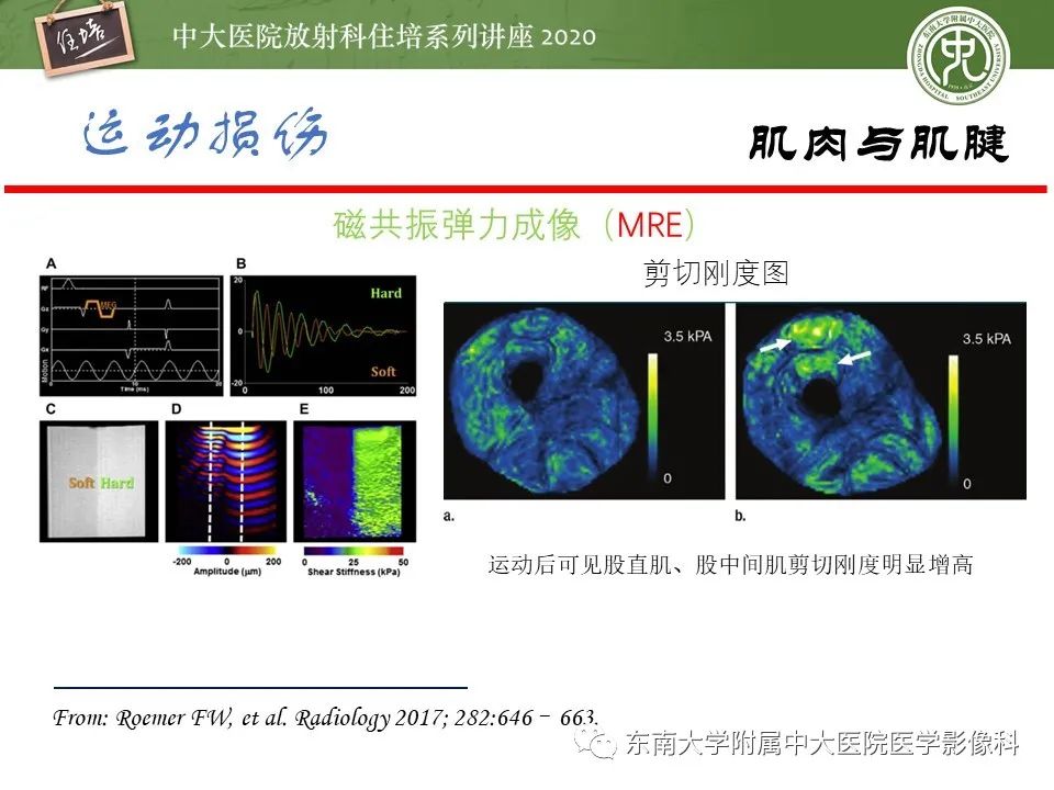 影像PPT - 【PPT】运动损伤的影像解读-47