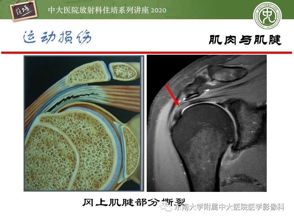 影像PPT - 【PPT】运动损伤的影像解读-48