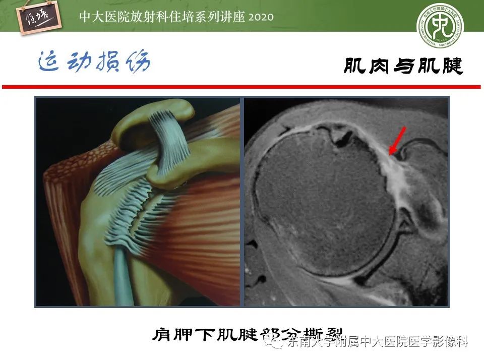 影像PPT - 【PPT】运动损伤的影像解读-49