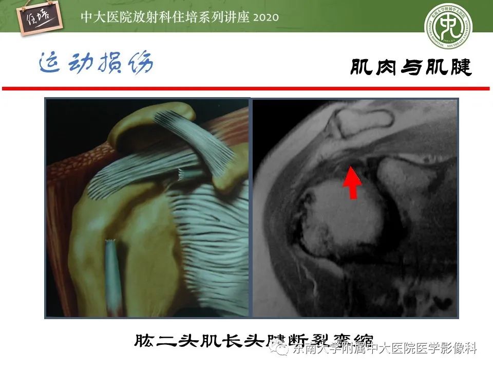 影像PPT - 【PPT】运动损伤的影像解读-50