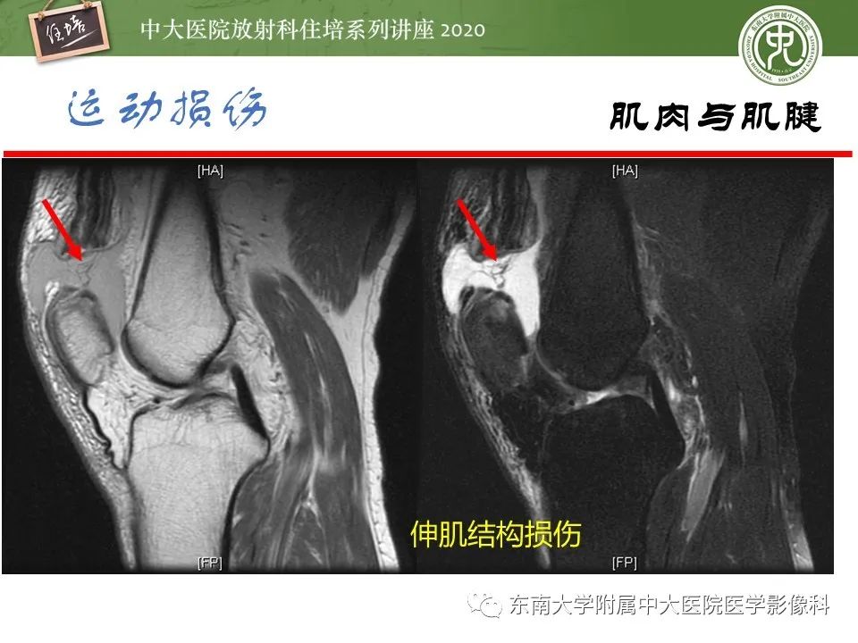 影像PPT - 【PPT】运动损伤的影像解读-51