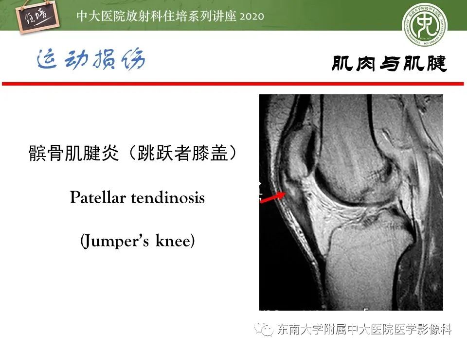 影像PPT - 【PPT】运动损伤的影像解读-52