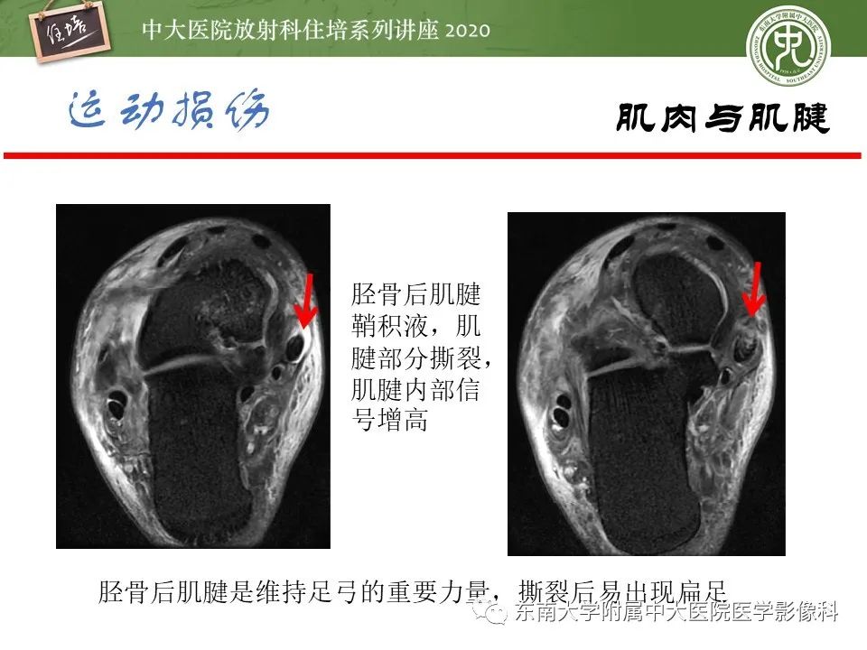 影像PPT - 【PPT】运动损伤的影像解读-53