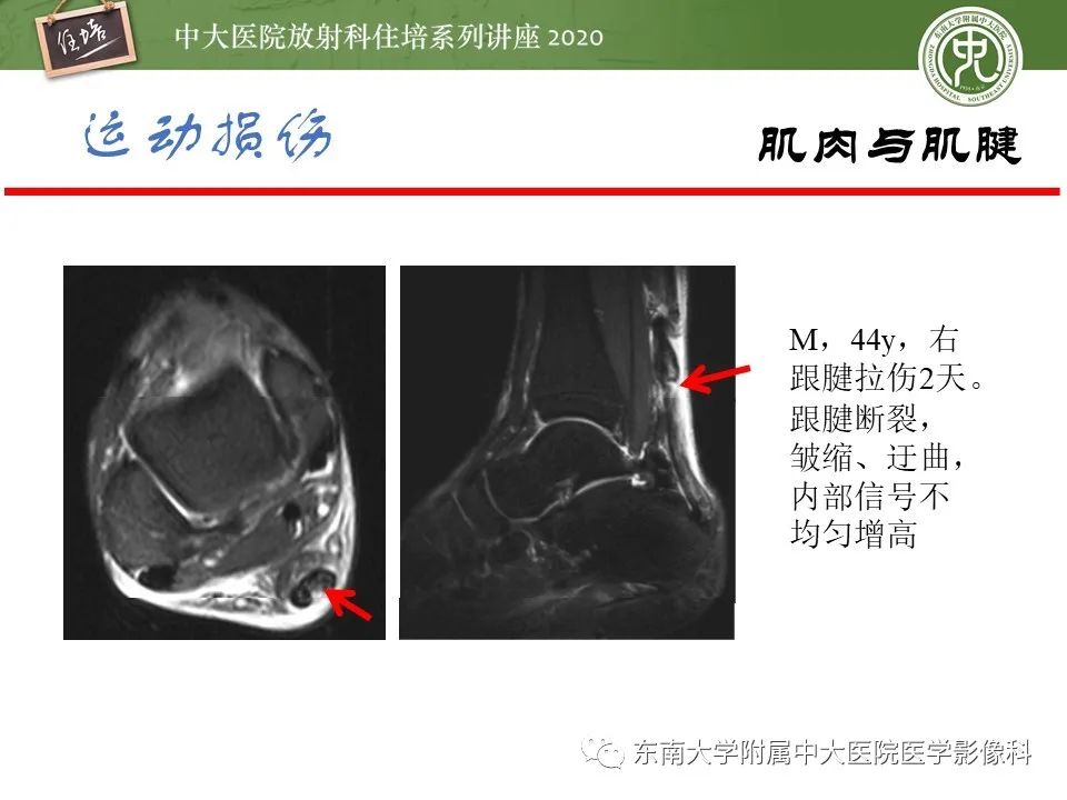 影像PPT - 【PPT】运动损伤的影像解读-54