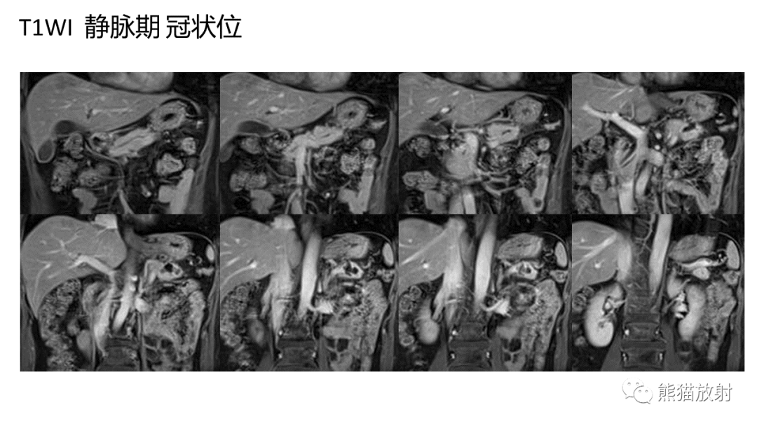 影像PPT - 【病例】粘液性囊腺瘤 VS 导管内乳头状粘液性肿瘤-23