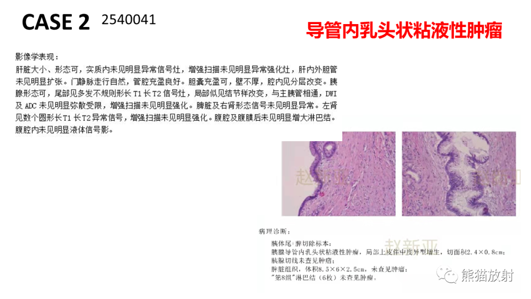 影像PPT - 【病例】粘液性囊腺瘤 VS 导管内乳头状粘液性肿瘤-28
