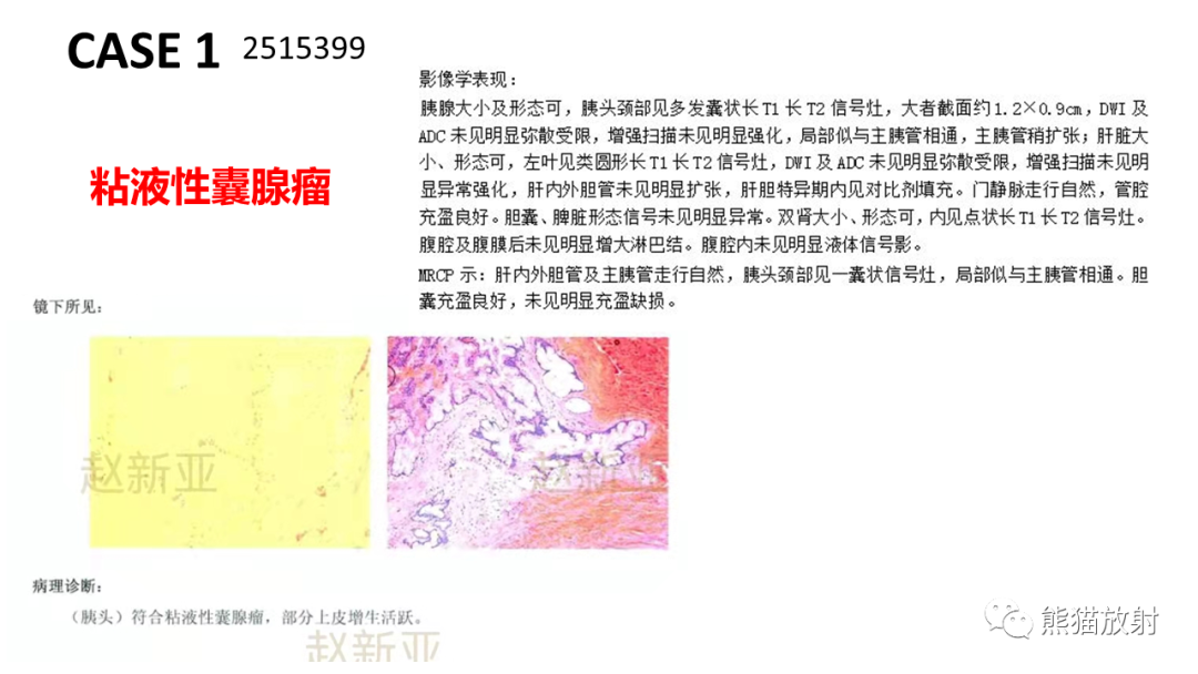 影像PPT - 【病例】粘液性囊腺瘤 VS 导管内乳头状粘液性肿瘤-27