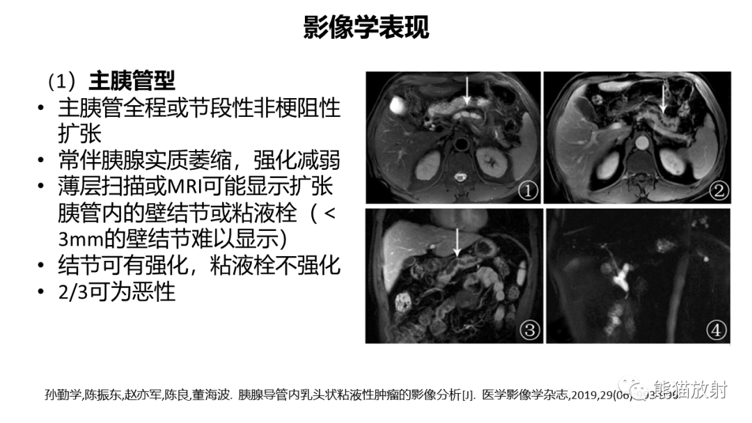 影像PPT - 【病例】粘液性囊腺瘤 VS 导管内乳头状粘液性肿瘤-33