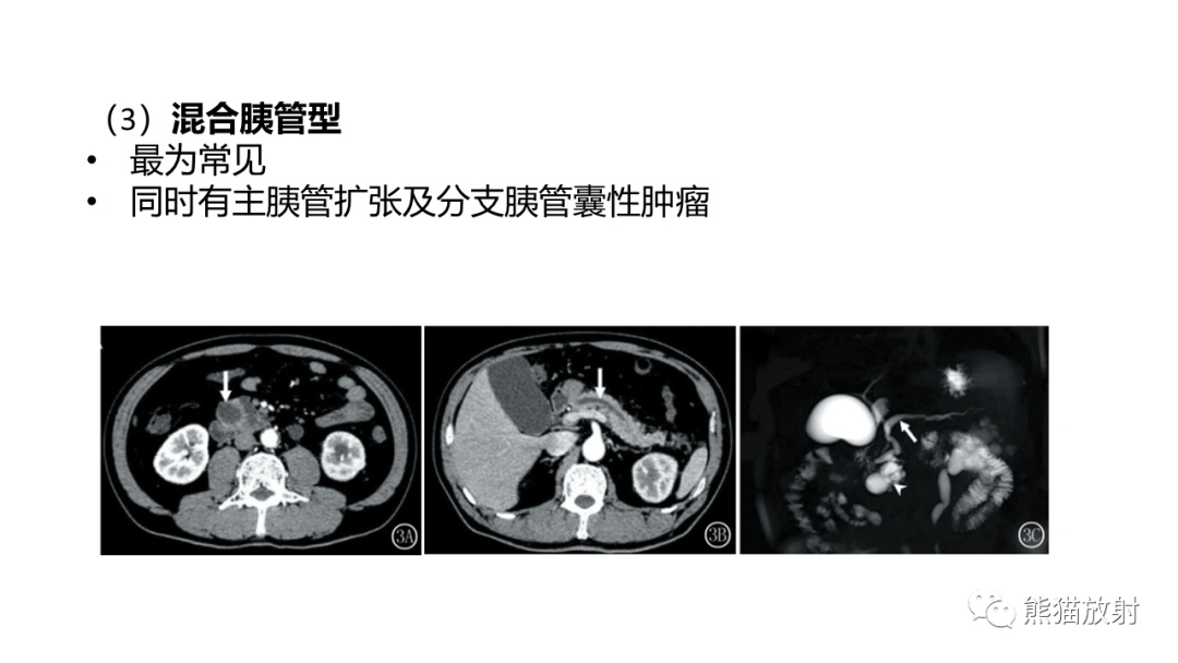 影像PPT - 【病例】粘液性囊腺瘤 VS 导管内乳头状粘液性肿瘤-35