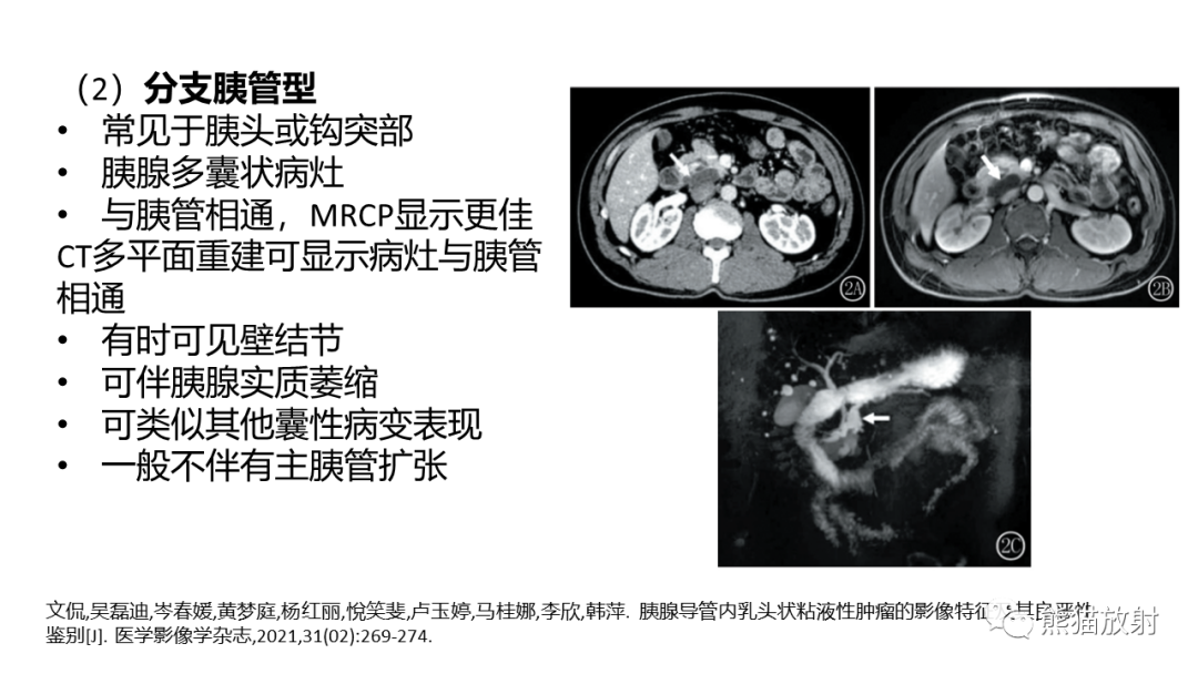 影像PPT - 【病例】粘液性囊腺瘤 VS 导管内乳头状粘液性肿瘤-34