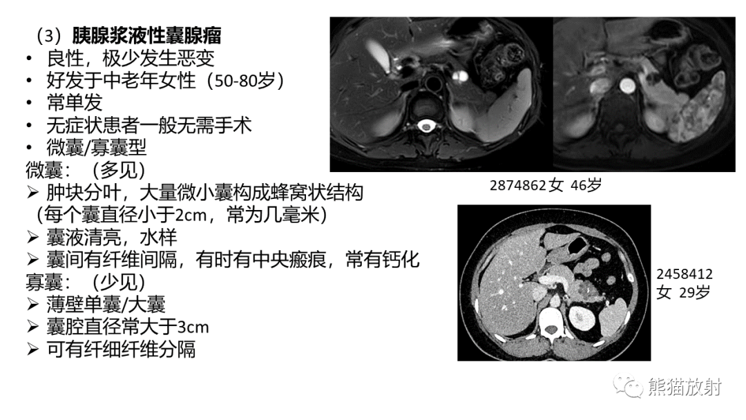 影像PPT - 【病例】粘液性囊腺瘤 VS 导管内乳头状粘液性肿瘤-40