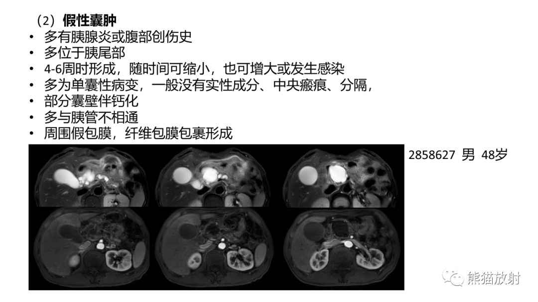 影像PPT - 【病例】粘液性囊腺瘤 VS 导管内乳头状粘液性肿瘤-39