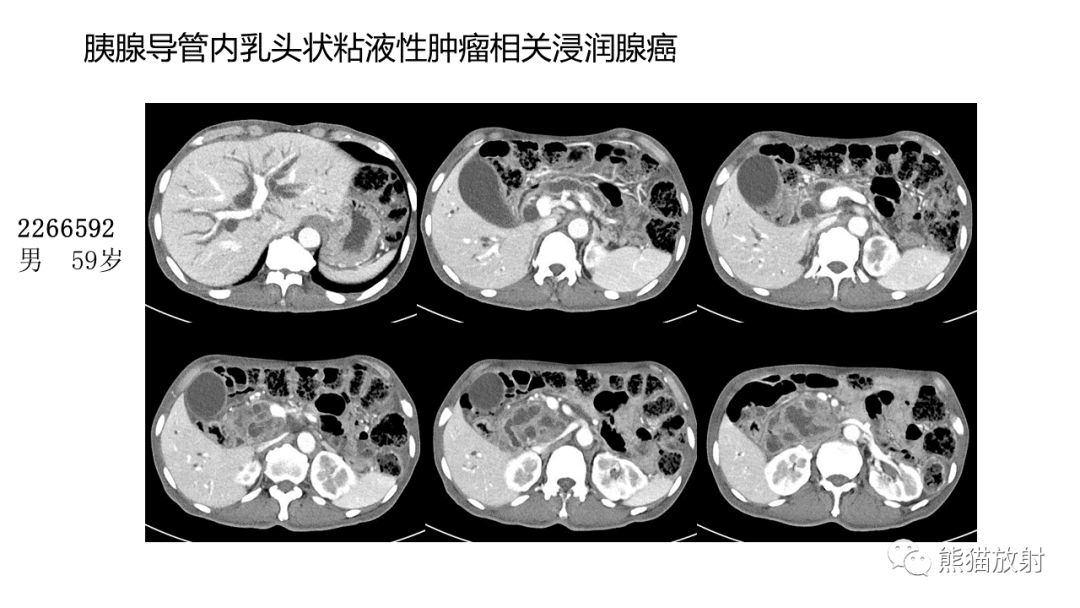 影像PPT - 【病例】粘液性囊腺瘤 VS 导管内乳头状粘液性肿瘤-37