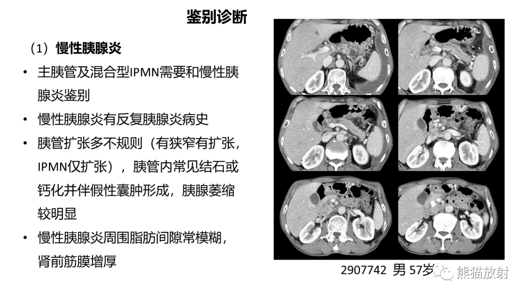 影像PPT - 【病例】粘液性囊腺瘤 VS 导管内乳头状粘液性肿瘤-38