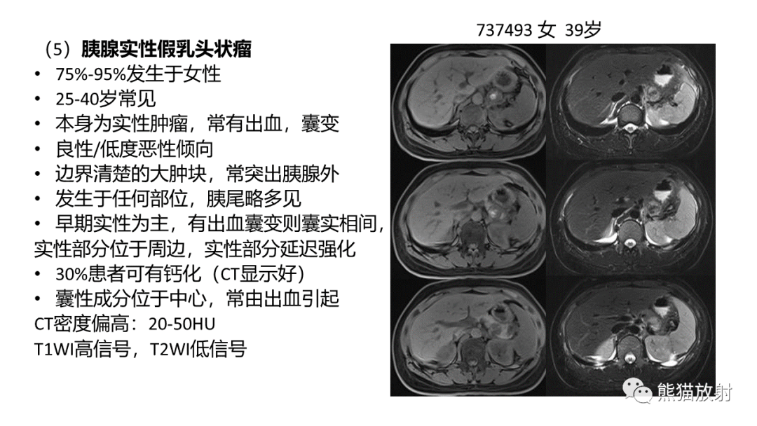 影像PPT - 【病例】粘液性囊腺瘤 VS 导管内乳头状粘液性肿瘤-42