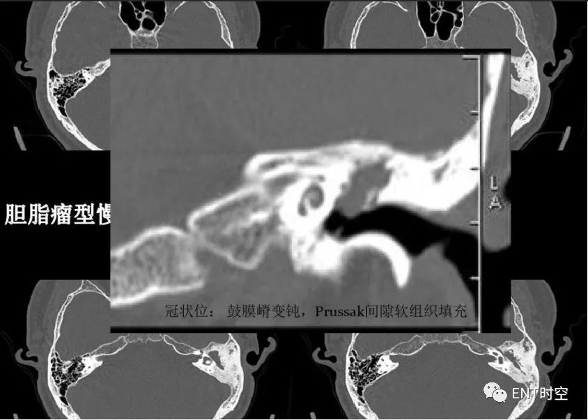 影像PPT - 慢性中耳乳突炎高分辨率HRCT-7 影像PPT - 慢性中耳乳突炎高分辨率HRCT-7
