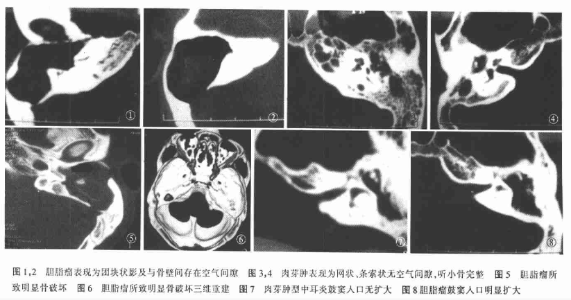 影像PPT - 慢性中耳乳突炎高分辨率HRCT-8 影像PPT - 慢性中耳乳突炎高分辨率HRCT-8