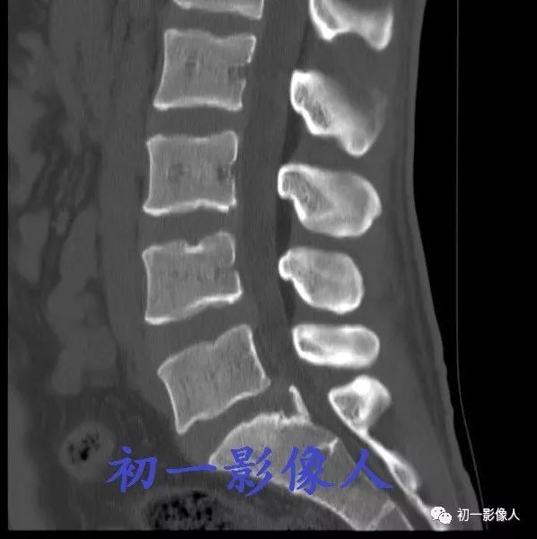 影像PPT - 腰椎后缘软骨结节-3 影像PPT - 腰椎后缘软骨结节-3