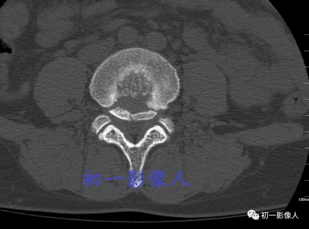 影像PPT - 腰椎后缘软骨结节-1 影像PPT - 腰椎后缘软骨结节-1