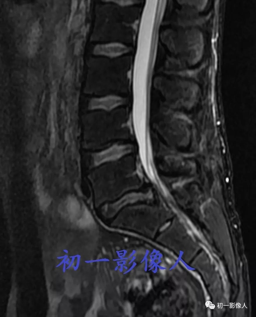 影像PPT - 腰椎后缘软骨结节-4 影像PPT - 腰椎后缘软骨结节-4