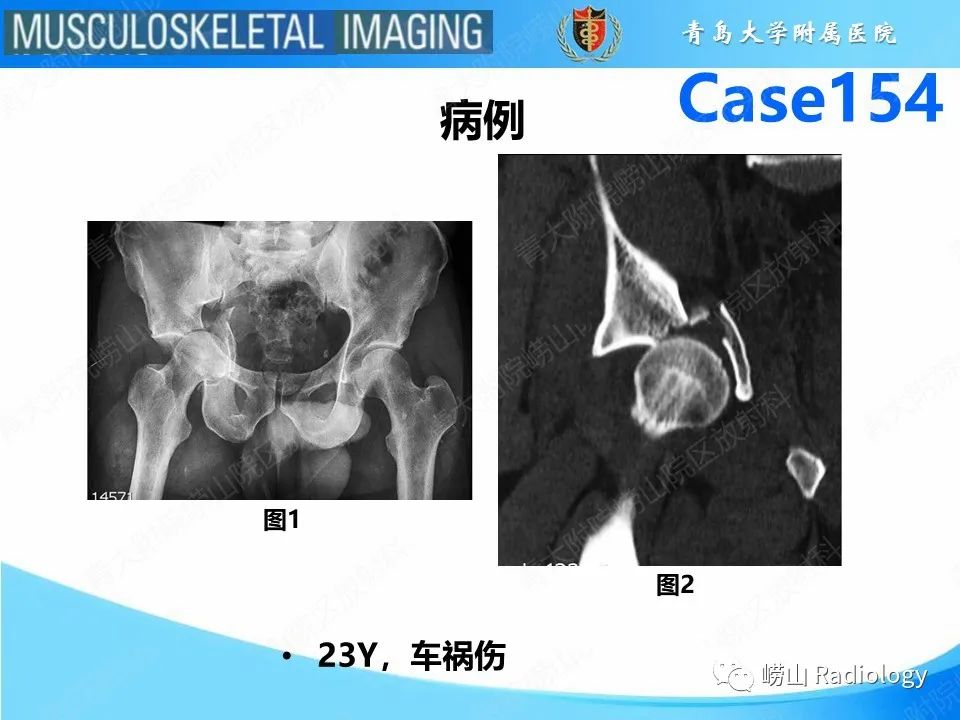 影像PPT - 【PPT】髋臼骨折-2