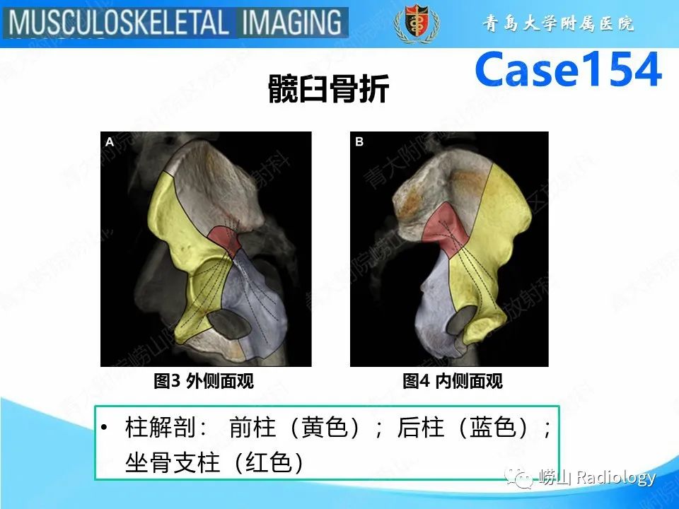 影像PPT - 【PPT】髋臼骨折-6