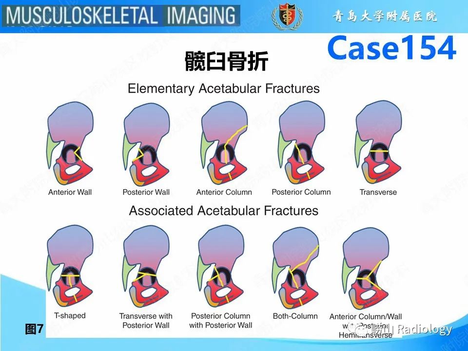 影像PPT - 【PPT】髋臼骨折-9
