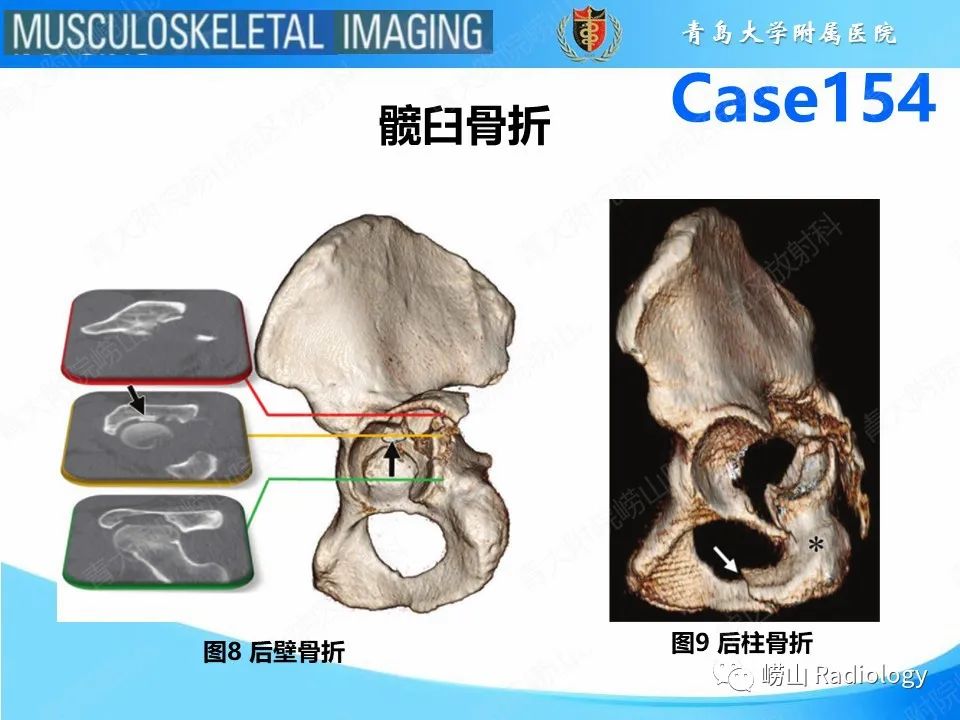 影像PPT - 【PPT】髋臼骨折-10