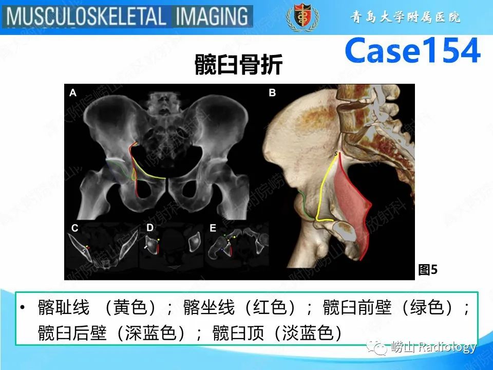影像PPT - 【PPT】髋臼骨折-7
