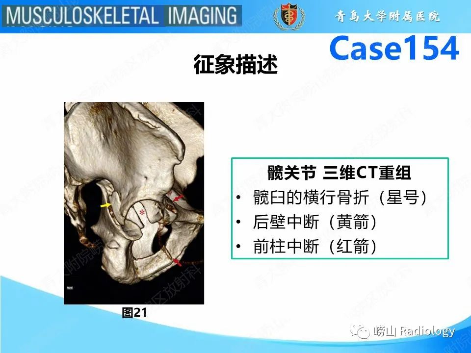 影像PPT - 【PPT】髋臼骨折-24
