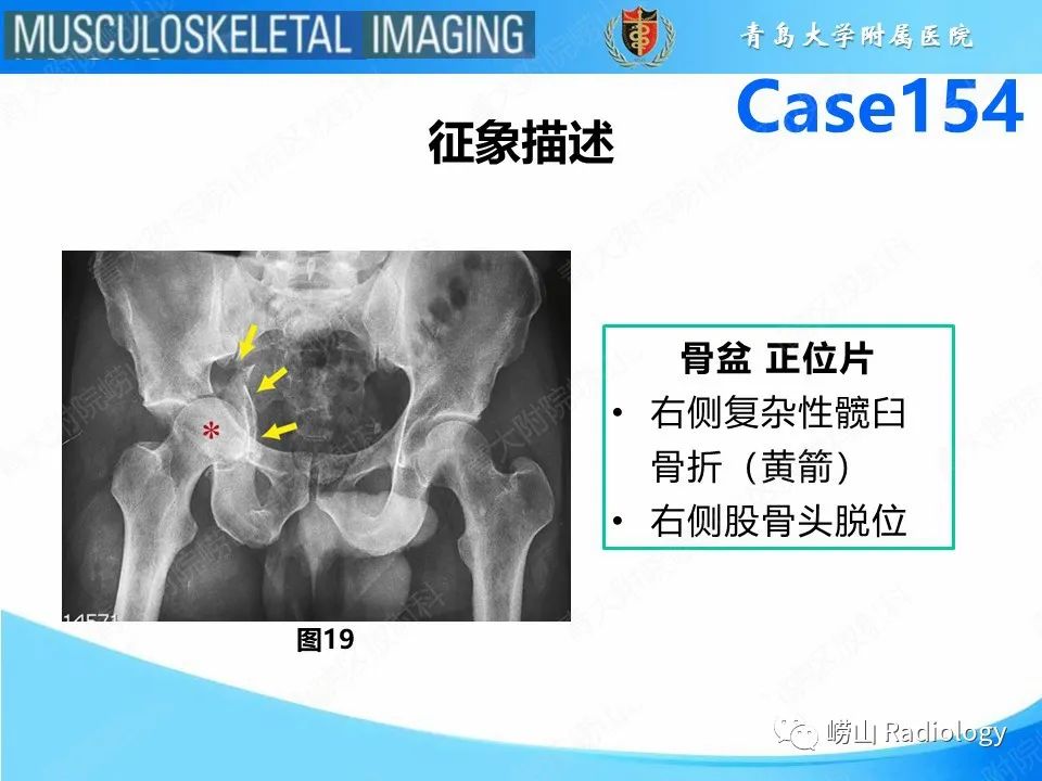 影像PPT - 【PPT】髋臼骨折-22