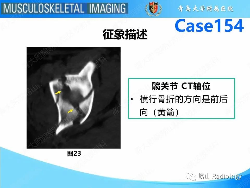 影像PPT - 【PPT】髋臼骨折-26
