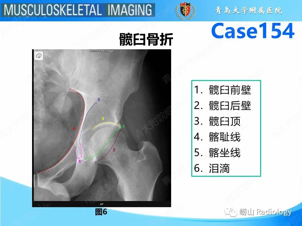 影像PPT - 【PPT】髋臼骨折-8