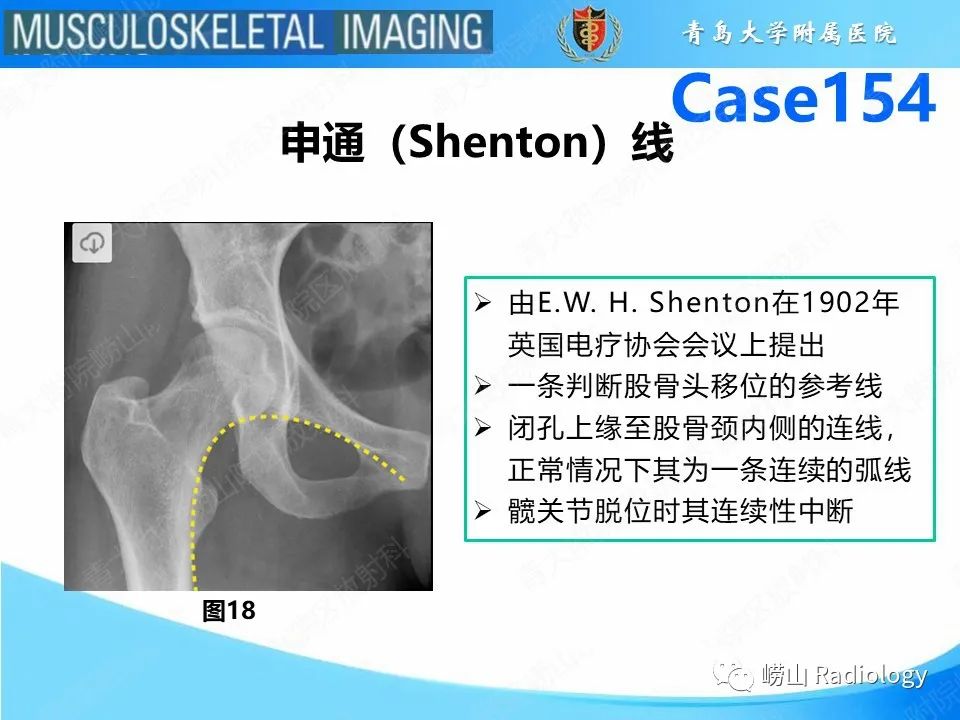 影像PPT - 【PPT】髋臼骨折-15
