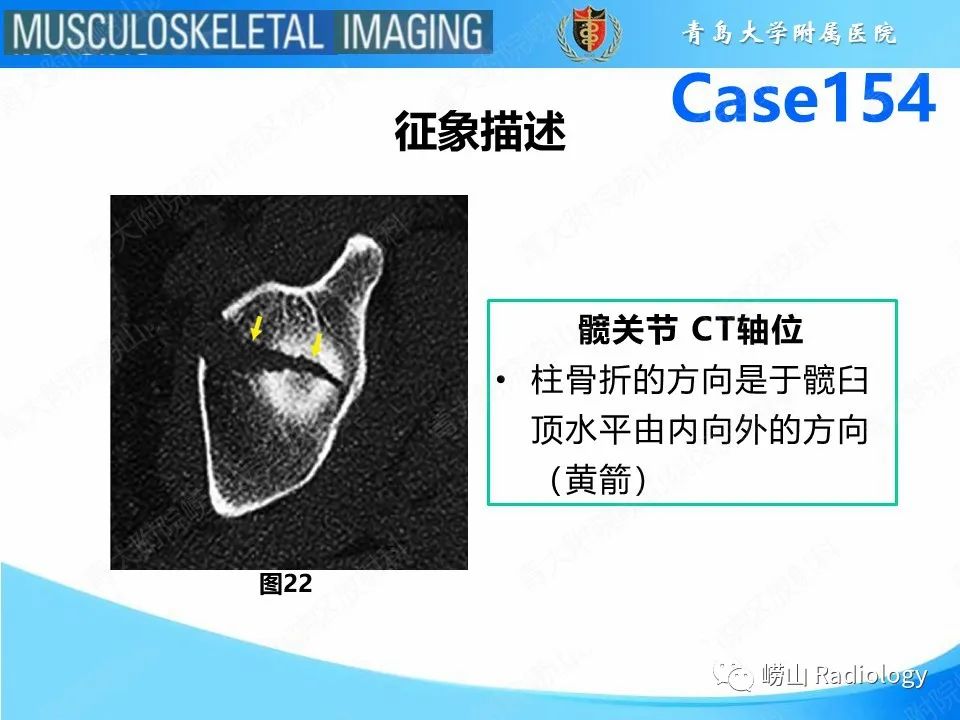 影像PPT - 【PPT】髋臼骨折-25