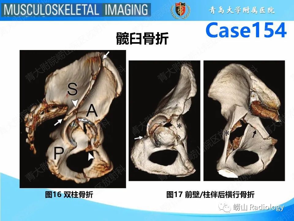 影像PPT - 【PPT】髋臼骨折-14