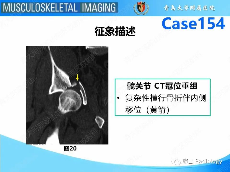 影像PPT - 【PPT】髋臼骨折-23