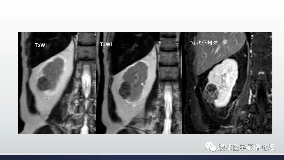 影像PPT - 【病例】肾嫌色细胞癌1例MR影像-10