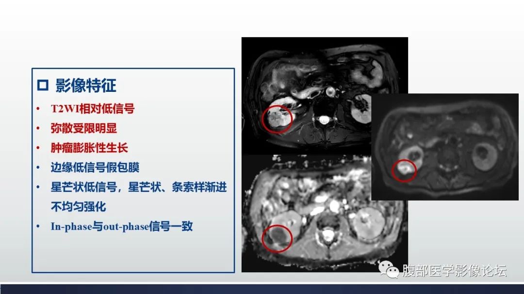 影像PPT - 【病例】肾嫌色细胞癌1例MR影像-15