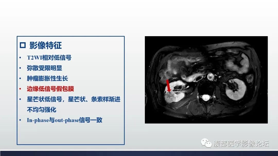 影像PPT - 【病例】肾嫌色细胞癌1例MR影像-16