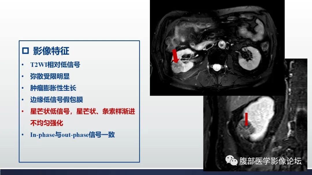 影像PPT - 【病例】肾嫌色细胞癌1例MR影像-17