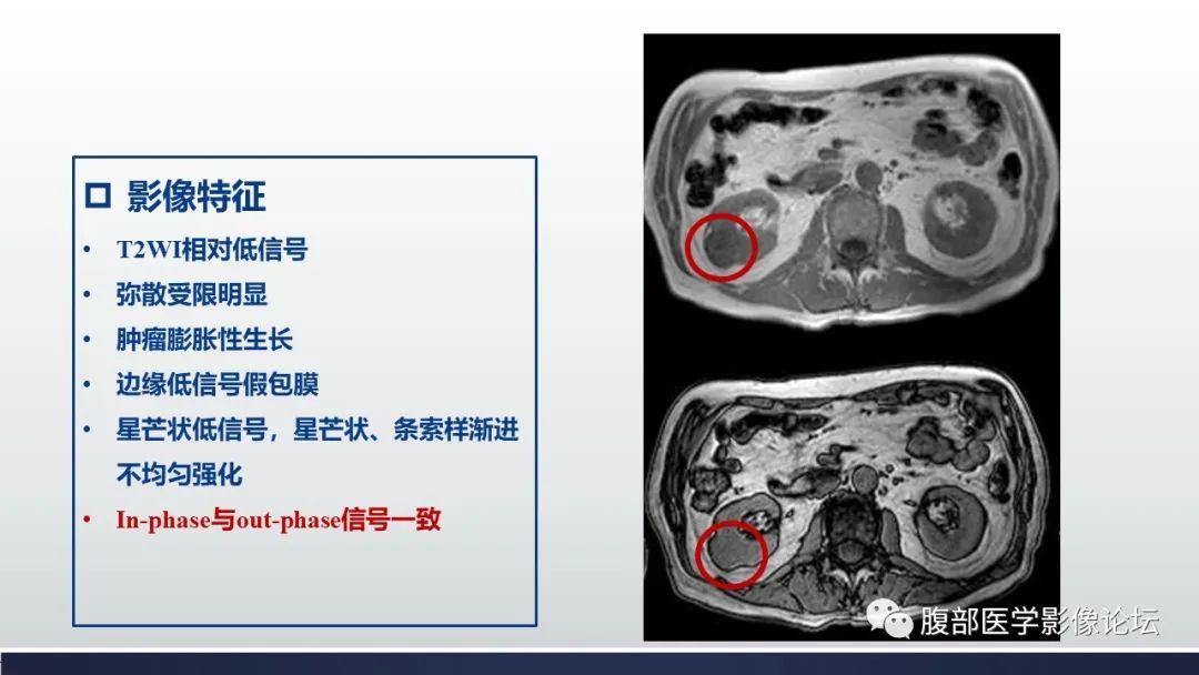 影像PPT - 【病例】肾嫌色细胞癌1例MR影像-18