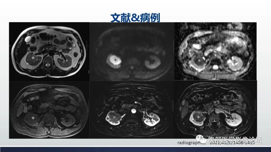 影像PPT - 【病例】肾嫌色细胞癌1例MR影像-20