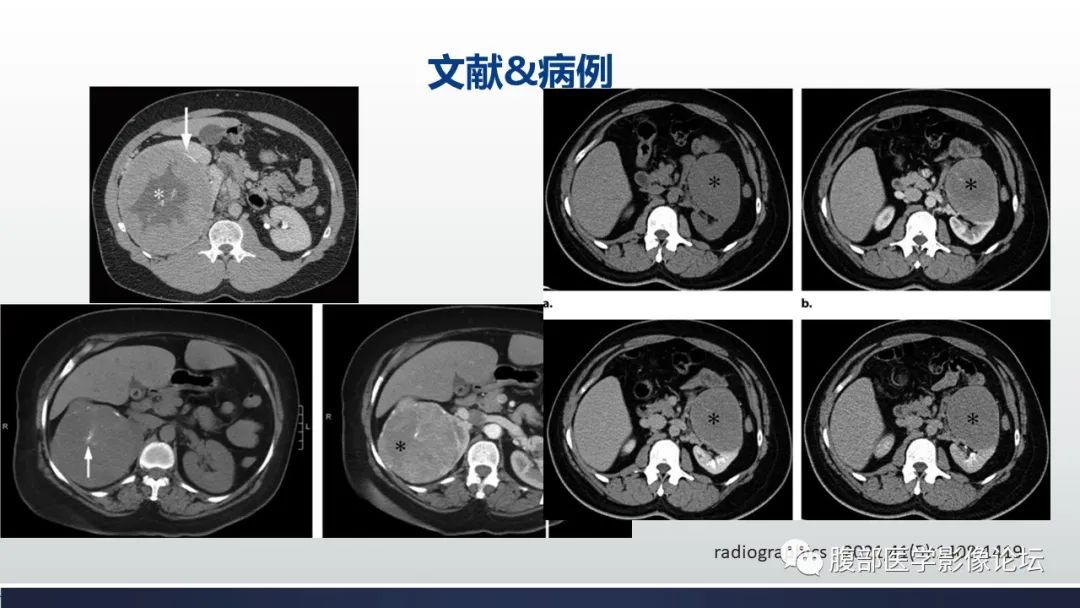 影像PPT - 【病例】肾嫌色细胞癌1例MR影像-19