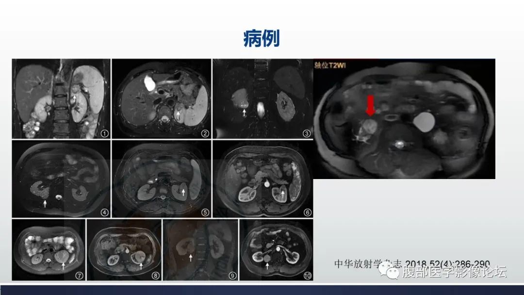 影像PPT - 【病例】肾嫌色细胞癌1例MR影像-27