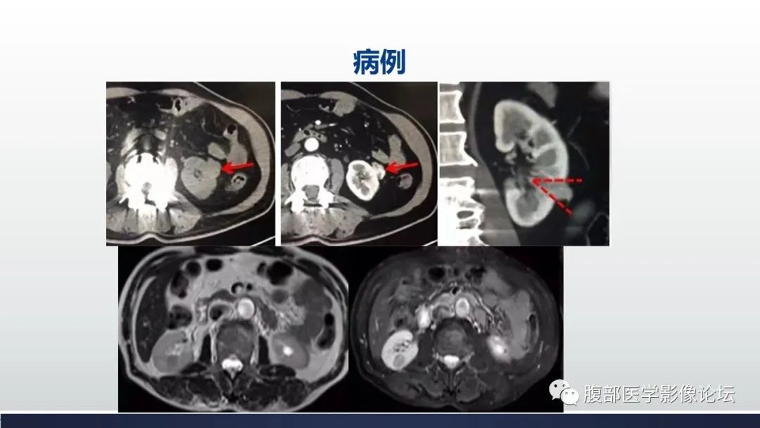 影像PPT - 【病例】肾嫌色细胞癌1例MR影像-24